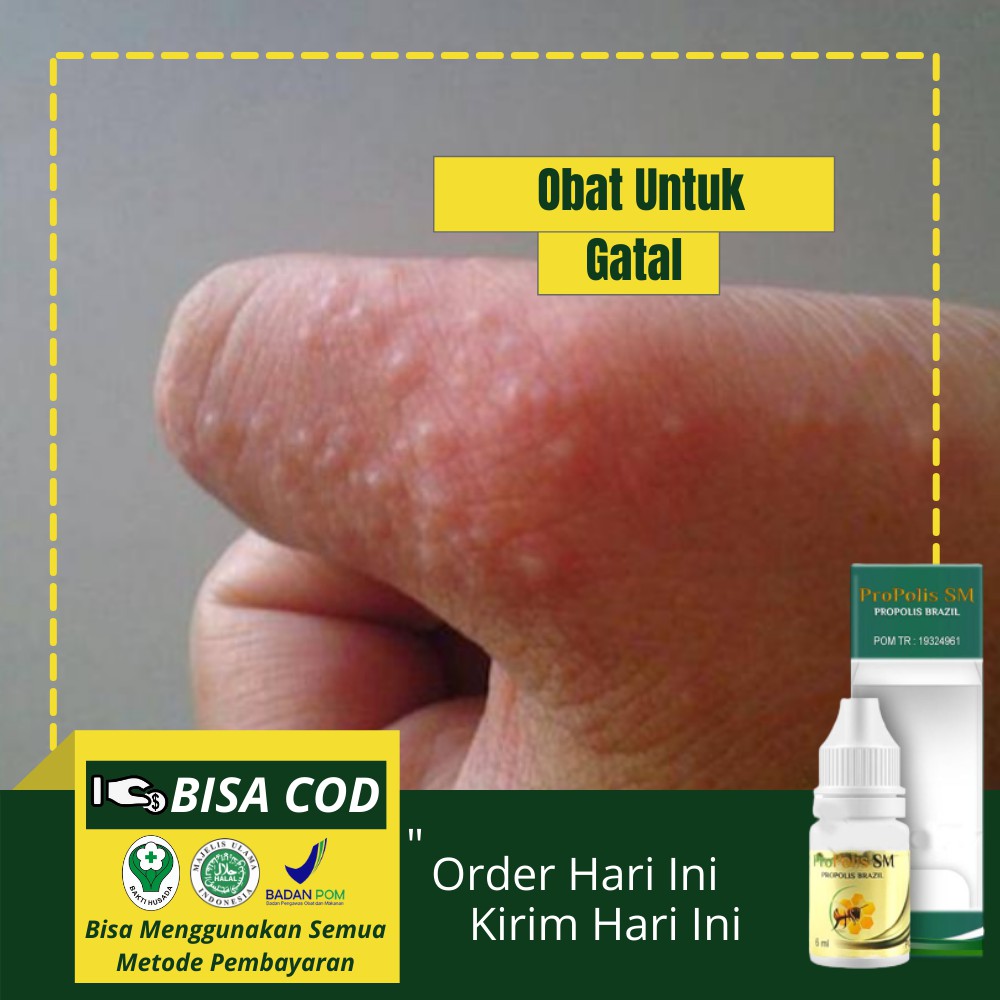 Obat Gatal Bintik Berair Di Tangan Herbal Jari Tangan Dan Bintik Berair Dengan Propolis Sm Shopee Indonesia