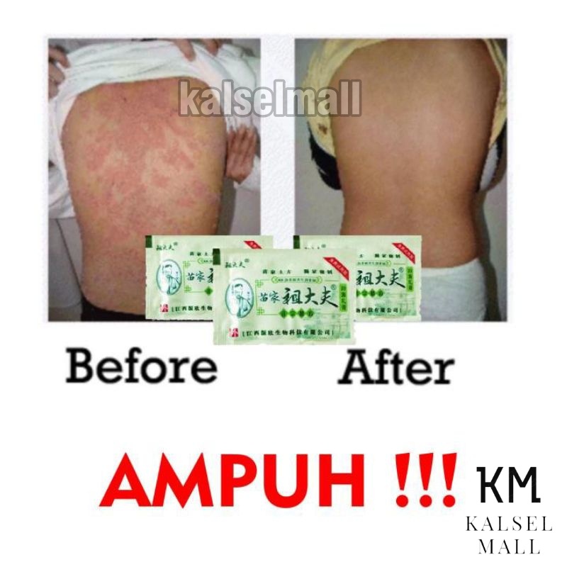 SALEP KRIM GATAL OBAT SALAP 100% ORIGINAL ZUDAIFU UNTUK SEMUA GATAL GATALAN SACHET ALERGI KULIT JAMURAN JERAWAT EKSIM PSOARISIS KUDIS PANU KURAP PANUAN SKABIES HERBAL EKSIM JAMUR KUTU AIR KEPUTIHAN SELANGKANGAN HERPES OBAT CINA ZHUDAIFU AMPUH ZUDAIPU OC2