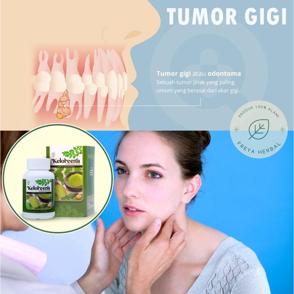 OBAT TUMOR GIGI, OBAT KANKER GIGI, OBAT HERBAL ODONTOMA