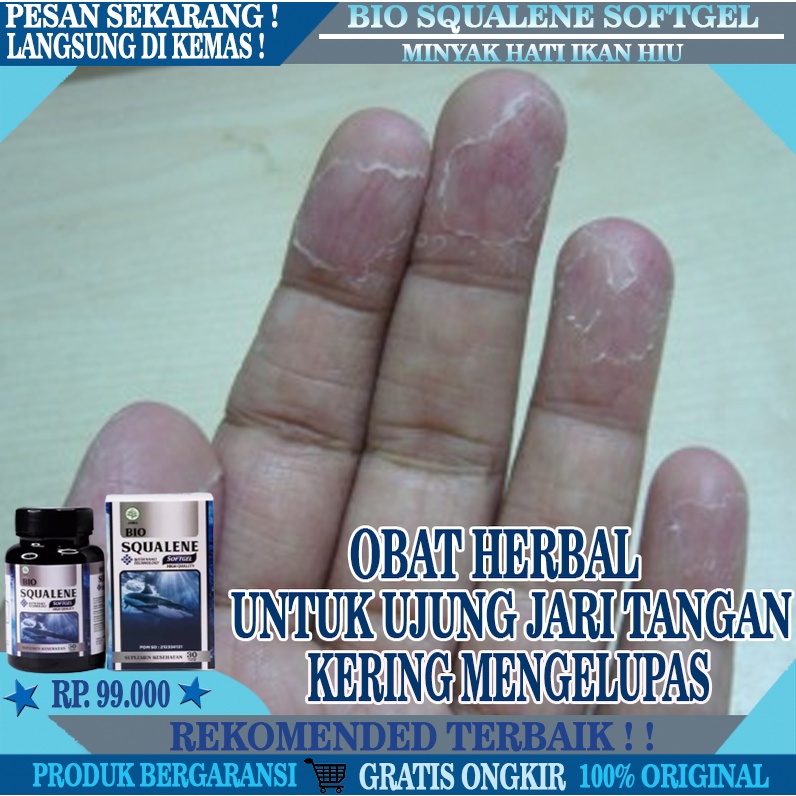 Obat Jari Tangan Kering, Obat Untuk Mengatasi Kulit Pecah-Pecah Pada Jari Tangan & Kaki, Obat Untuk 