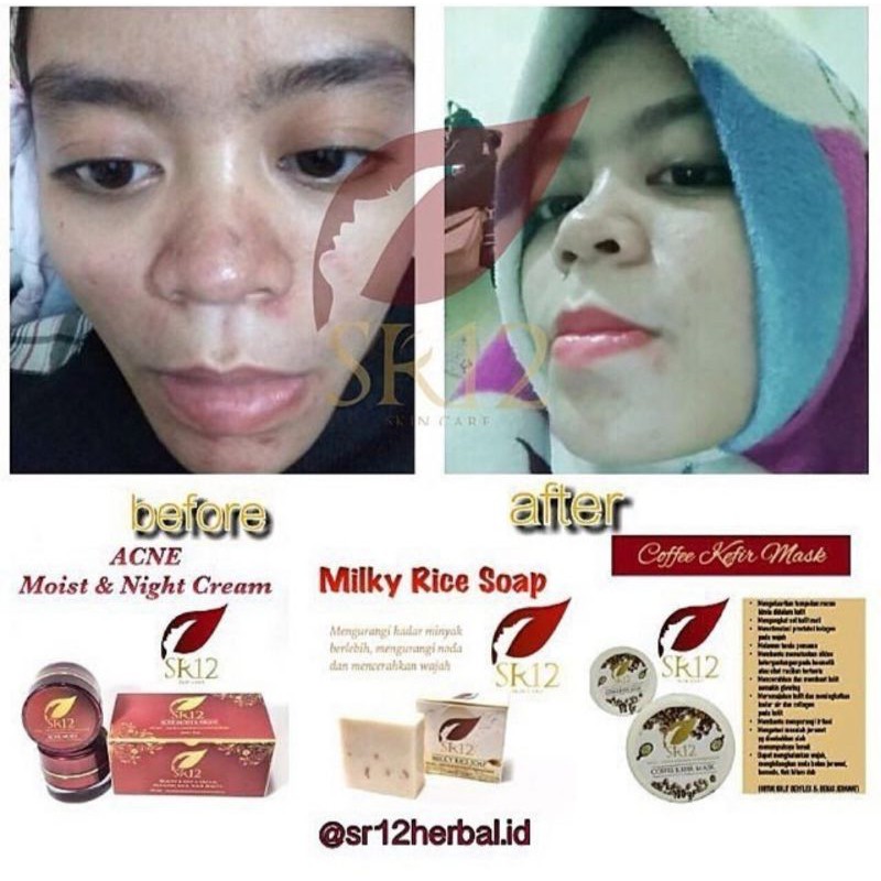 

KRIM TUMPAS JERAWAT BPOM / ACNE MOIST CREAM SR12 / BEKAS JERAWAT / MENCERAHKAN WAJAH / KERUTAN WAJA