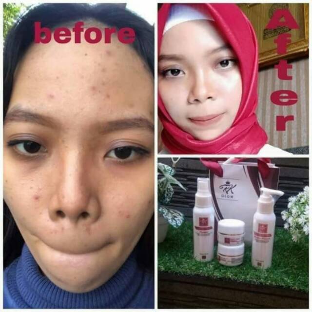 Skincare RK glow acne BPOM