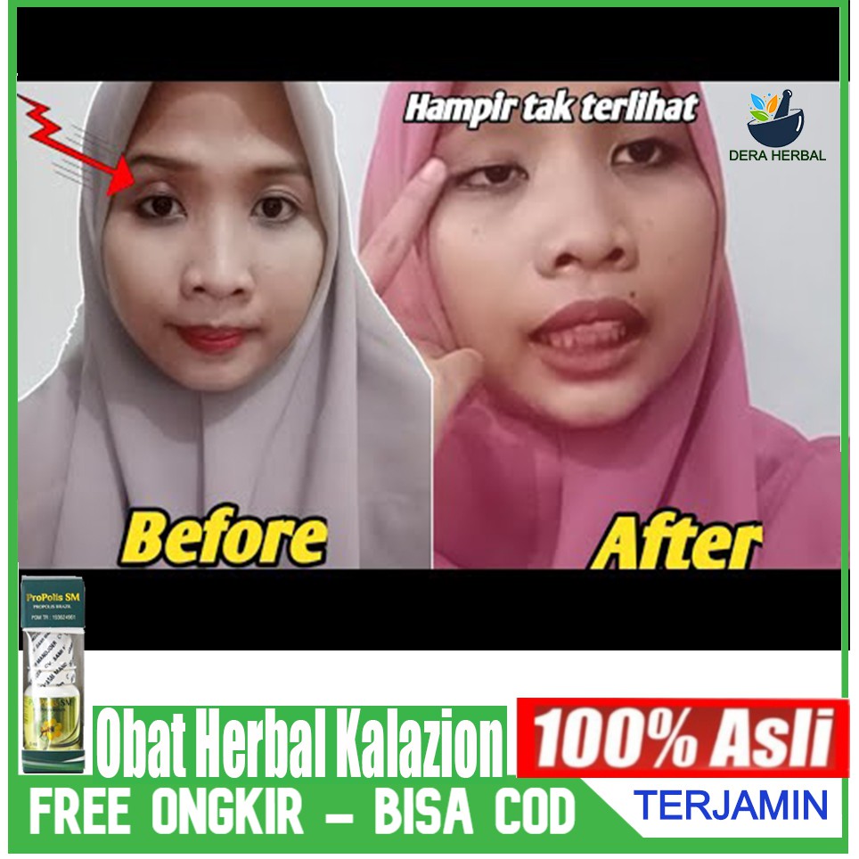 Obat Herbal Alami atasi Kalazion Propolis Sm Original Gold Terbukti Khasiatnya