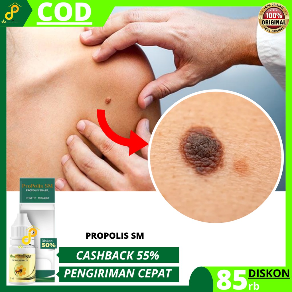 OBAT HERBAL MELANOMA, OBAT MELANOMA, OBAT KANKER KULIT PSM COD