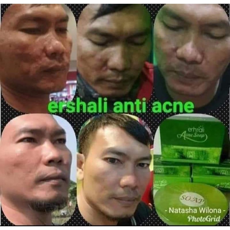Sabun Ershalie Acne nasa