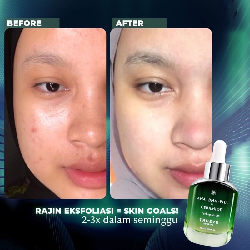 TRUEVE - PEELING AHA BHA PHA &amp; CERAMIDE SERUM 15ml (Exfoliating Serum,Serum Jerawat,Obat Jerawat)