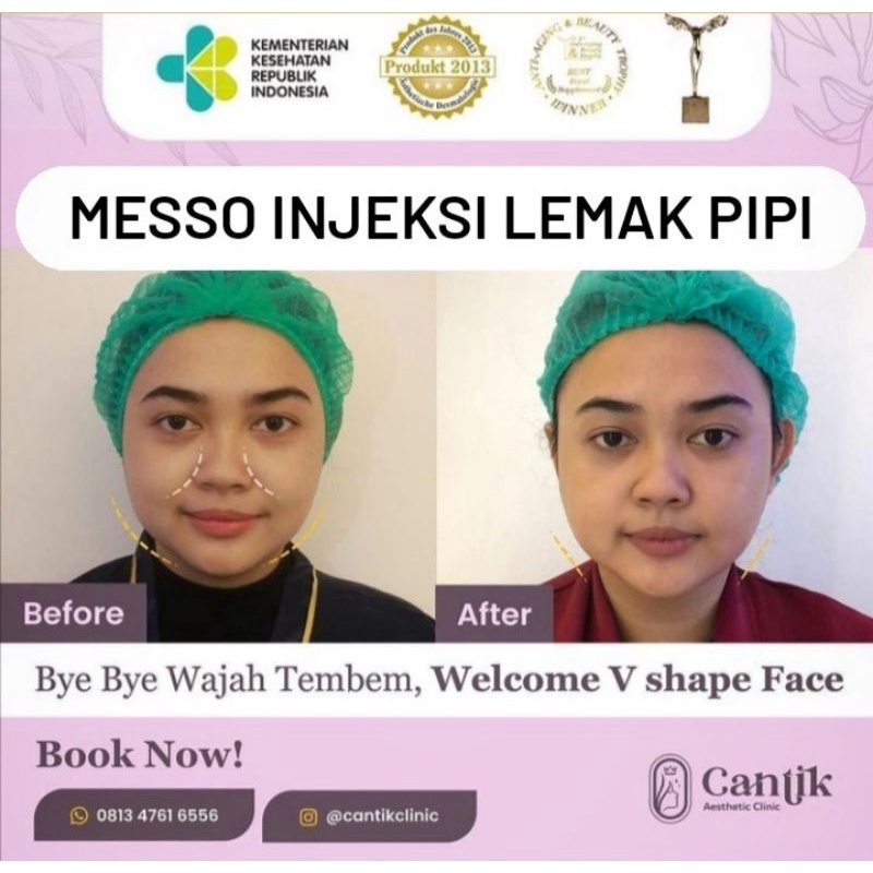 MESSO INJEKSI LEMAK PIPI