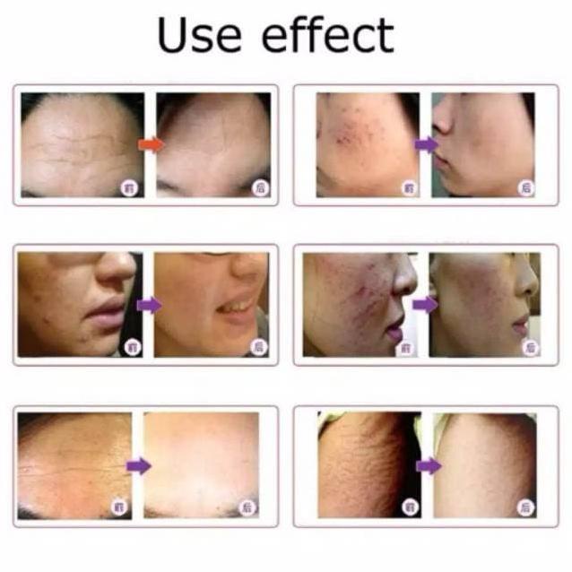 ALAT BB GLOW DERMA PEN MY M MYM DERMAPEN PENGHILANG BOPENG SULAM BEDAK