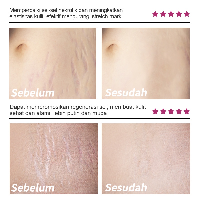 [BPOM]RtopR Mangga Menghilangkan Bekas Kehamilan Krim Jerawat Stretch Marks Perawatan Bersalin Perbaikan Anti-Penuaan Anti-Keriput Mengencangkan Krim Tubuh 40g