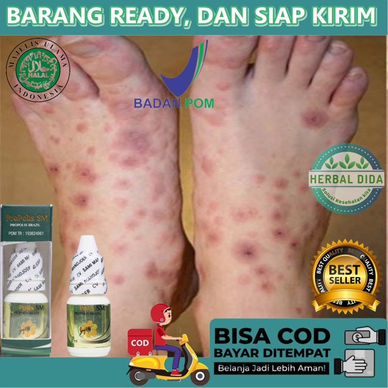 Obat Penghilang Koreng di Kaki, Obat Penghilang Bekas Luka Lama Hitam Koreng, Obat Penghilang Koreng
