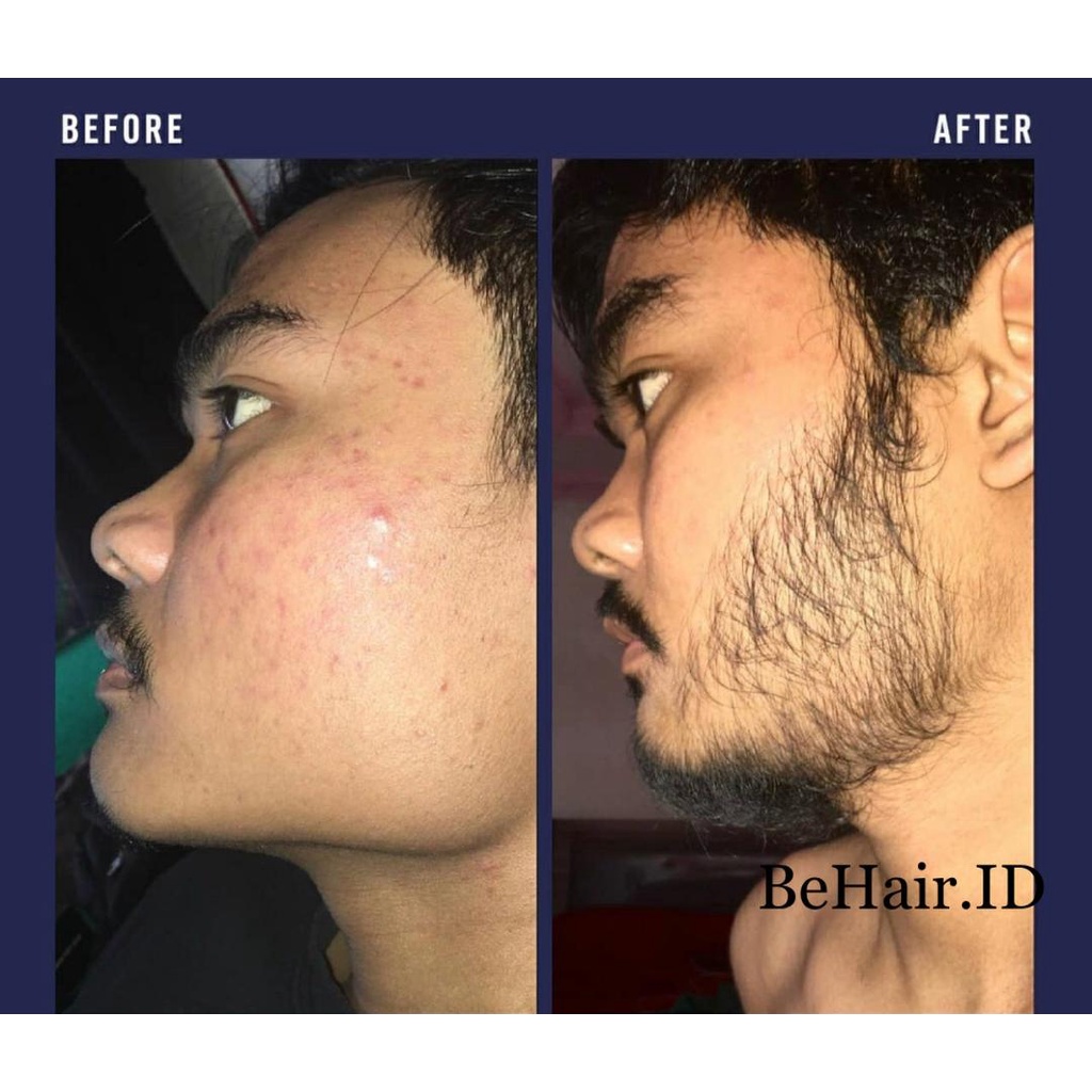 TERLARIS Serum Liquid BIOFINMIX BeHaird.ID BOURN BEARD Finmix Cave Biotin Finasteridee Minoxidil 5% BeHairId Penumbuh Jambang Kumis Alis Rambut Brewok Mencegah Kerontokan Kebotakan Uban ketombe ASLI ORIGINAL 100% Serum Beard OIL Penumbuh Brewok