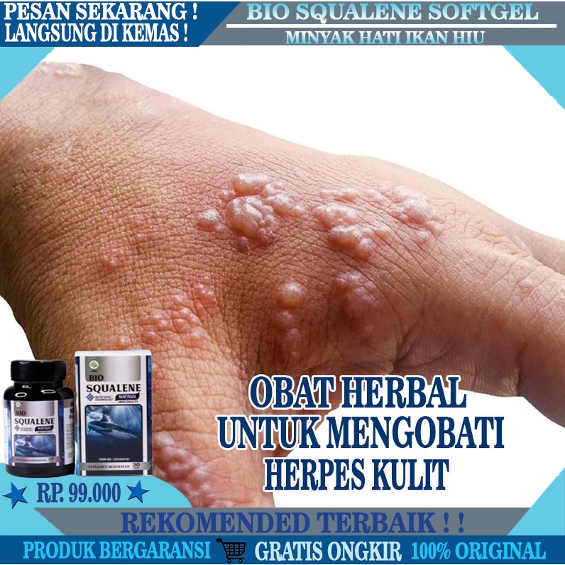 Obat Herpes Kulit, Obat Ruam Merah Di Kulit, Obat Penghilang Herpes Gatal Di Kulit, Obat Herbal Herp