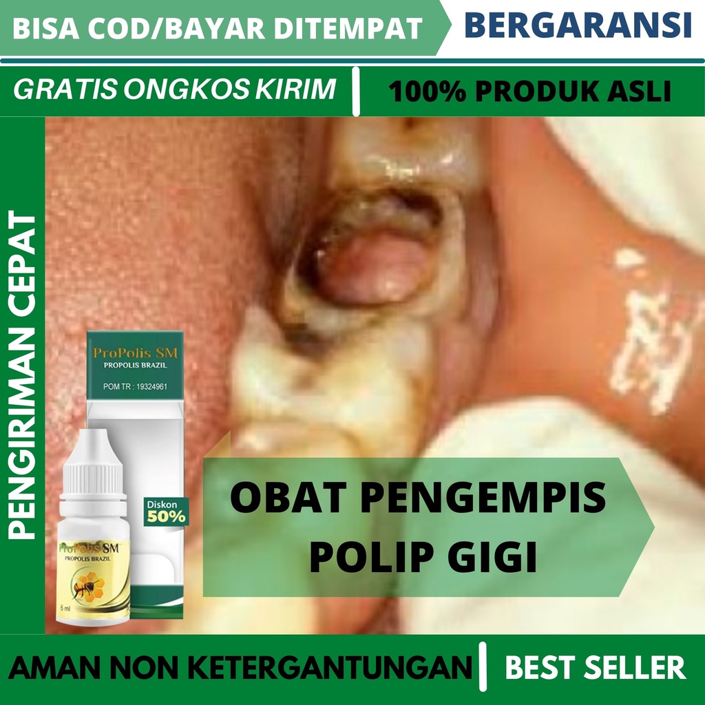 Jual Obat Polip Gigi Benjolan Digusi Gusi Berdarah Sakit Bengkak Gigi Bolong Gigi Hitam