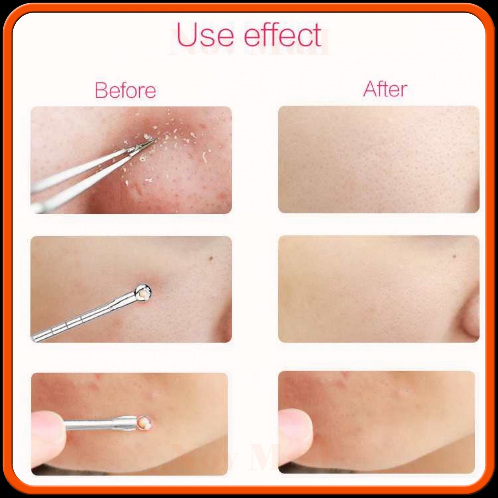 Alat Perlengkapan Komedo Jerawat Blackhead 3 PCS - PT3