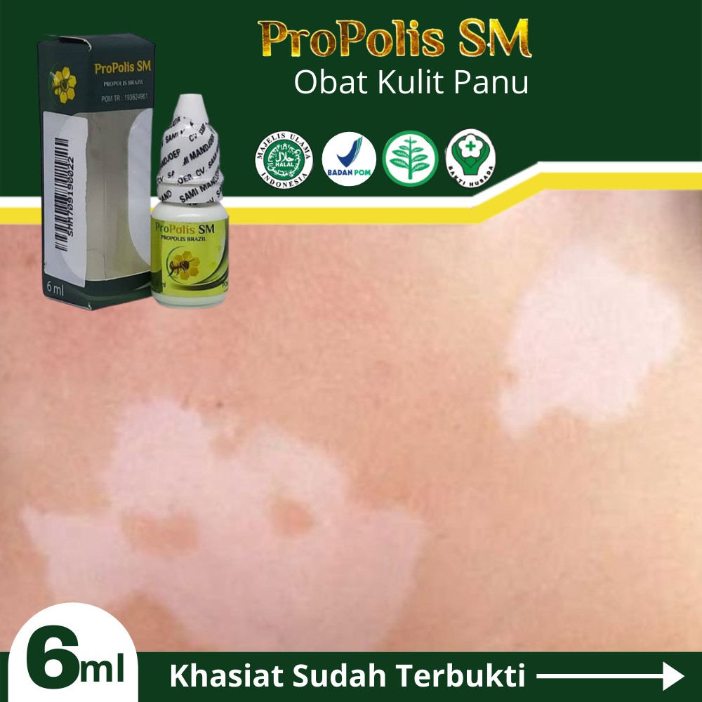 Jual Obat Kulit Panuan, GatalGatal, Jamur Kulit, Obat Penyakit Kulit