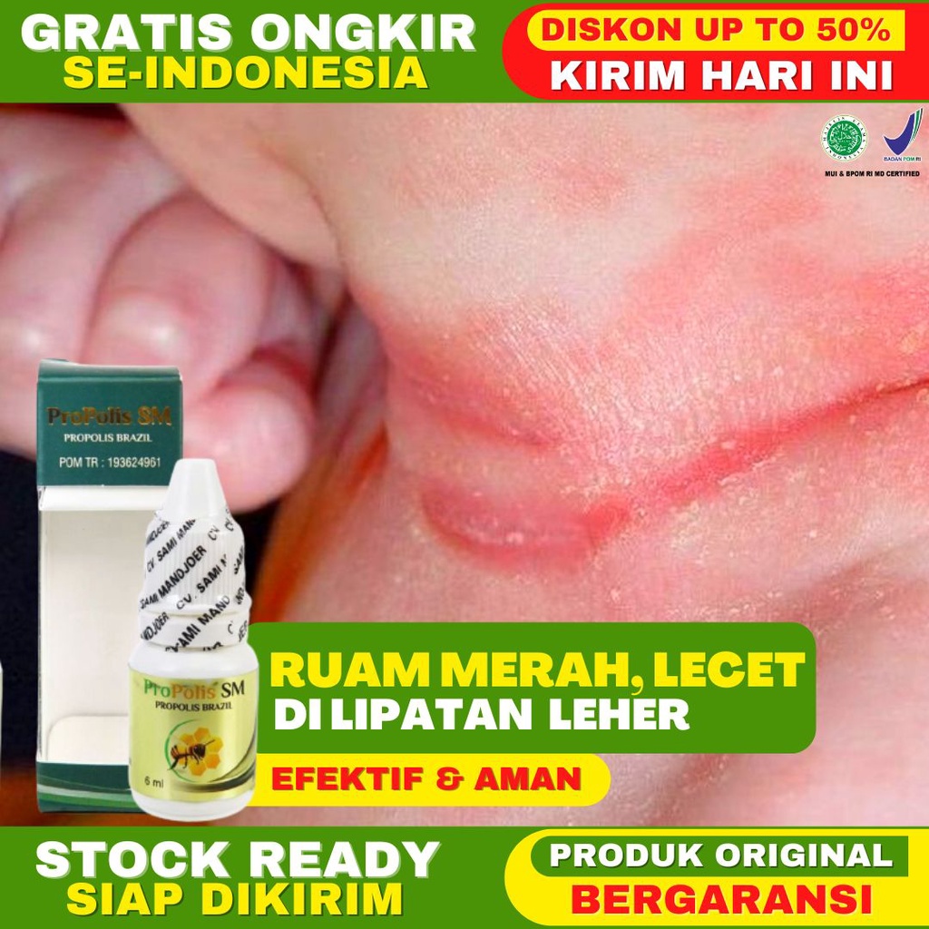 Obat Ruam di Leher Bayi Ruam Merah di Leher Anak Lecet di Lipatan Leher Biang Keringat Leher Bayi Le