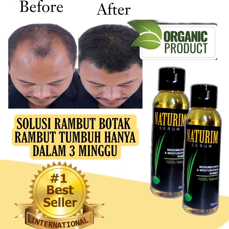Serum penumbuh rambut botak dan rontok pria anak bayi cepat