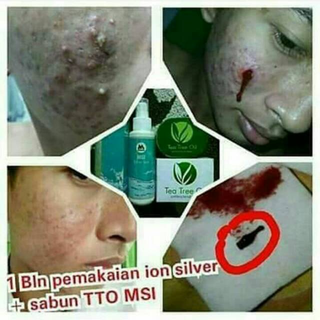 Tea tree oil