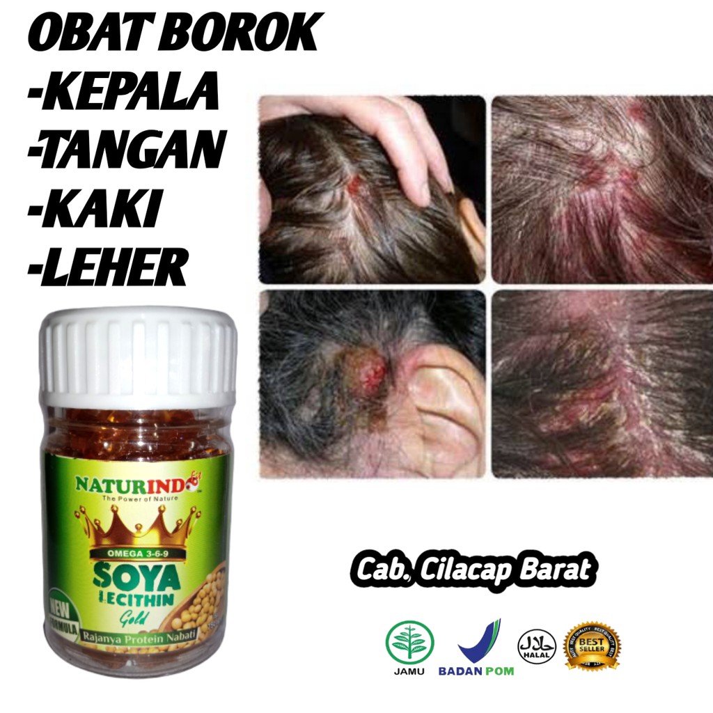 Obat Borok Kepala Gatal Kulit Kepala Tangan Kaki Borok Kepala Korengan Herbal Original Shopee Indonesia