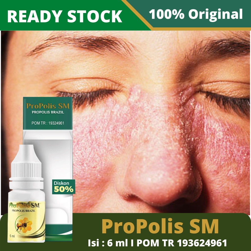 Obat Lupus, Obat Herbal Lupus, Obat Lupus Alami, Obat Lupus Tradisional, Obat Lupus Resep Dokter, Obat Sakit Lupus, Obat Penghilang Lupus, Obat Penyakit Lupus, Infeksi Kulit, Bercak Merah Dimuka – ProPolis SM 100% Original BPOM