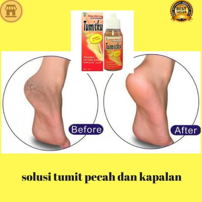 Tumitku Obat Herbal Kaki Pecah BPOM Original Asli Obat Kaki Kapalan 30ml Solusi Kaki Pecah Kapalan