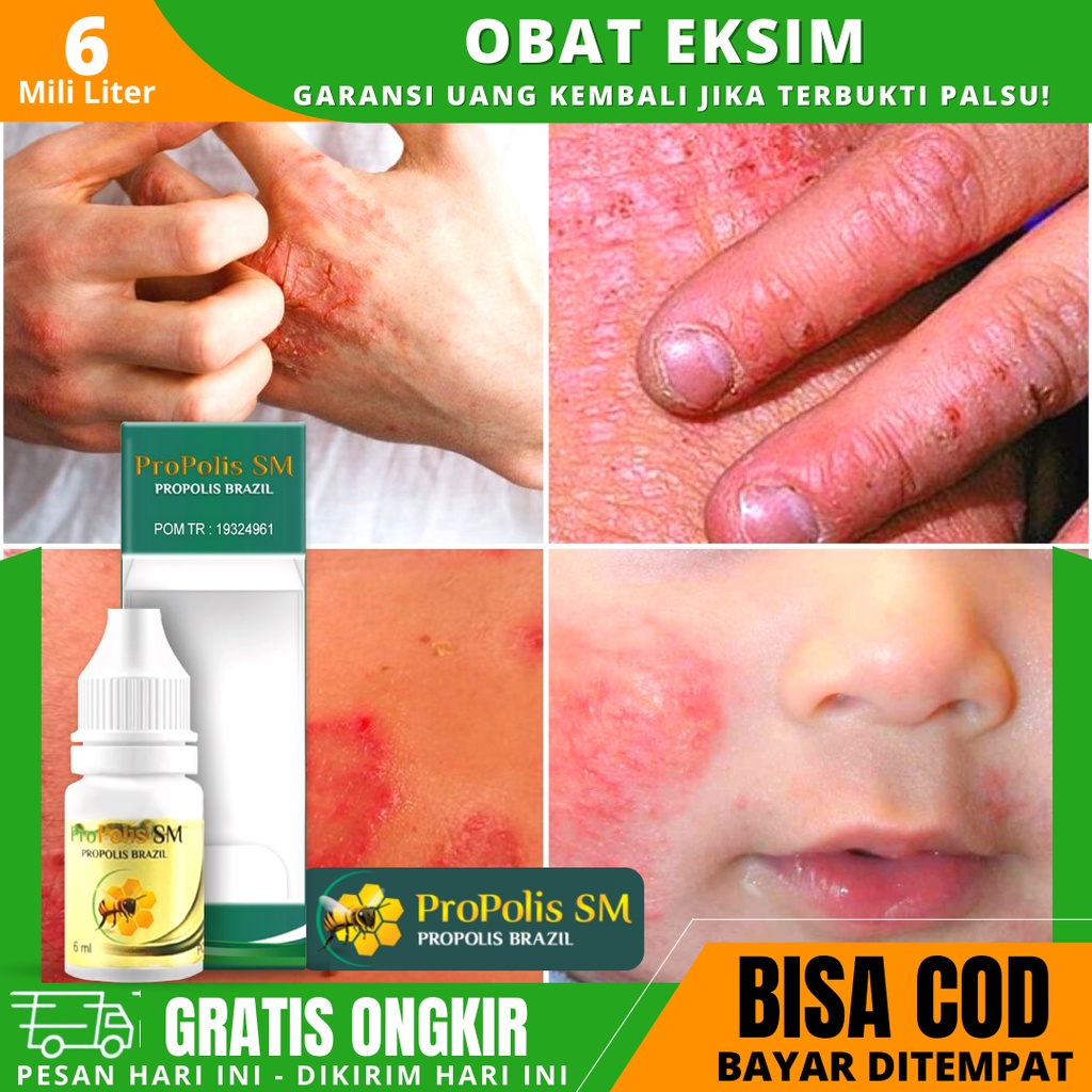 Obat Eksim, Obat Tetes Penghilang Eksim Basah & Kering, Eksim Menahun, Eksim Gatal - PROPOLIS SM
