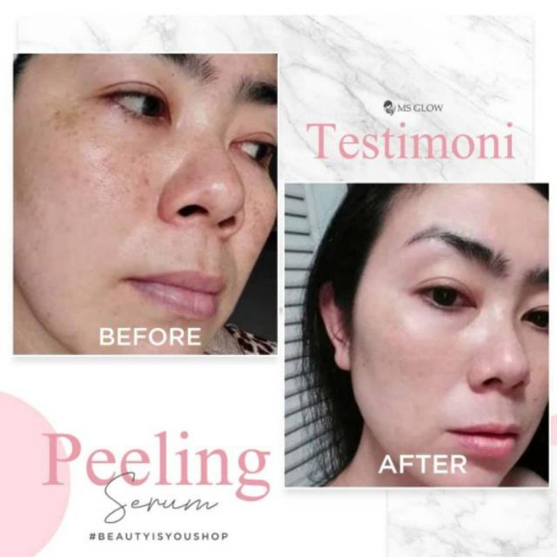 SERUM PEELING ORIGINAL MS GLOW (SUSAH BER BARCODE)