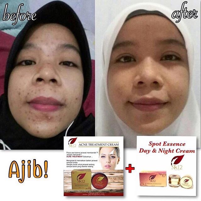 SR12 ACNE TREATMENT CREAM KRIM JERAWAT MERADANG &amp; MEMBANDEL AMPUH HILANGKAN JERAWAT