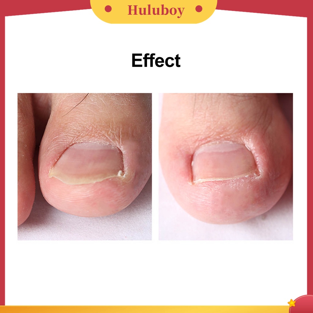 Huluboy Huluboy♡ Gunting Kuku Kaki Kutikula Universal Bahan Stainless Steel Untuk Pedicure