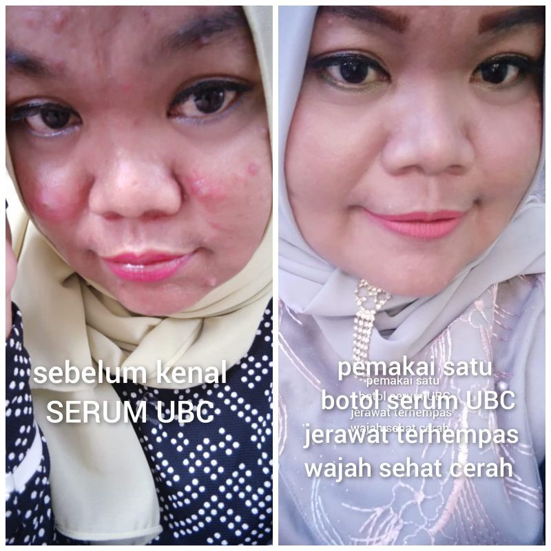 SERUM ACNE SERUM JERAWAT UBC ACNE SPOT SERUM BPOM