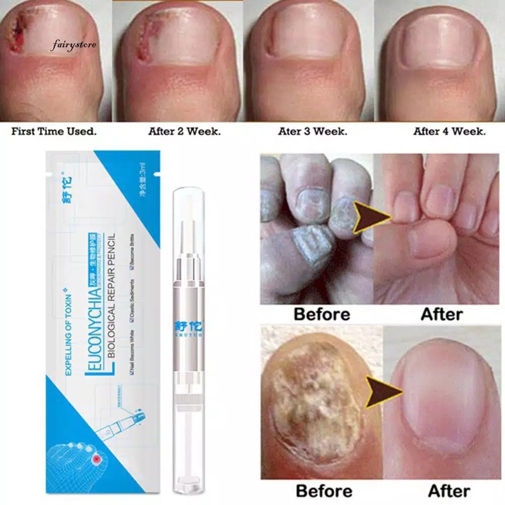 Obat Jamur Kuku Kaki Dan Kuku Tangan