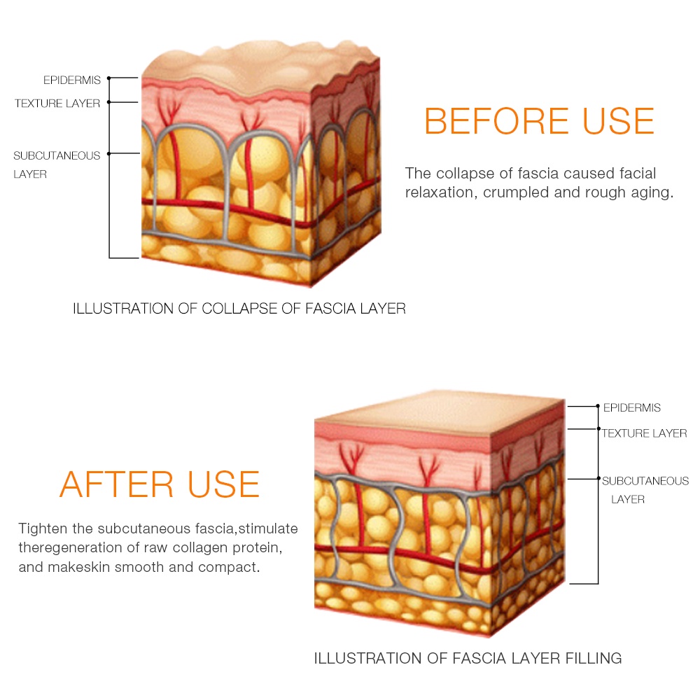 ALAT TERAPI ULTRASONIC MINI HIFU