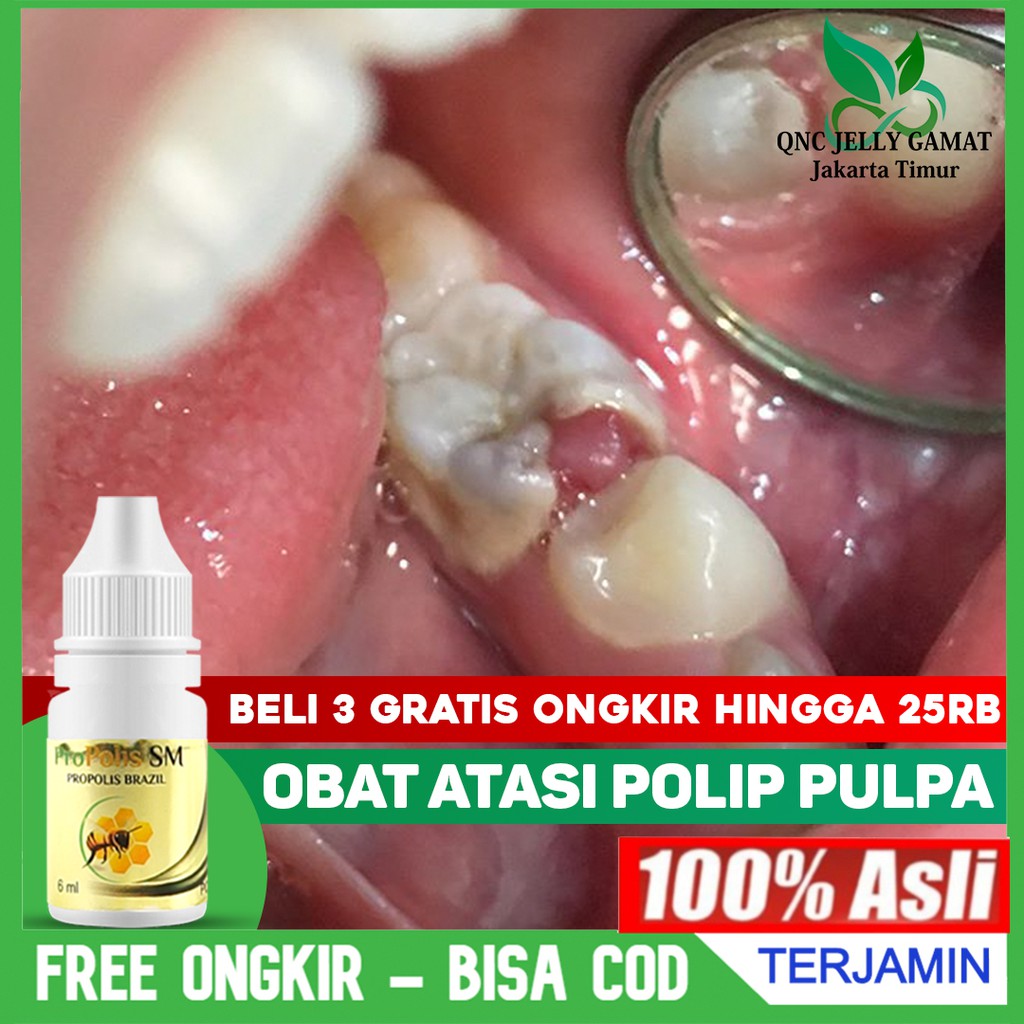 Obat Polip Pulpa Gigi Polip Gusi Gusi Bengkak Bernanah Berdarah Radang Herbal Propolis Sm Shopee Indonesia