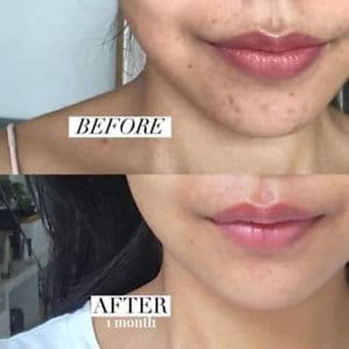 Mederma Advanced Scar Gel - #1 Doctor & Pharmacist Recommended Brand