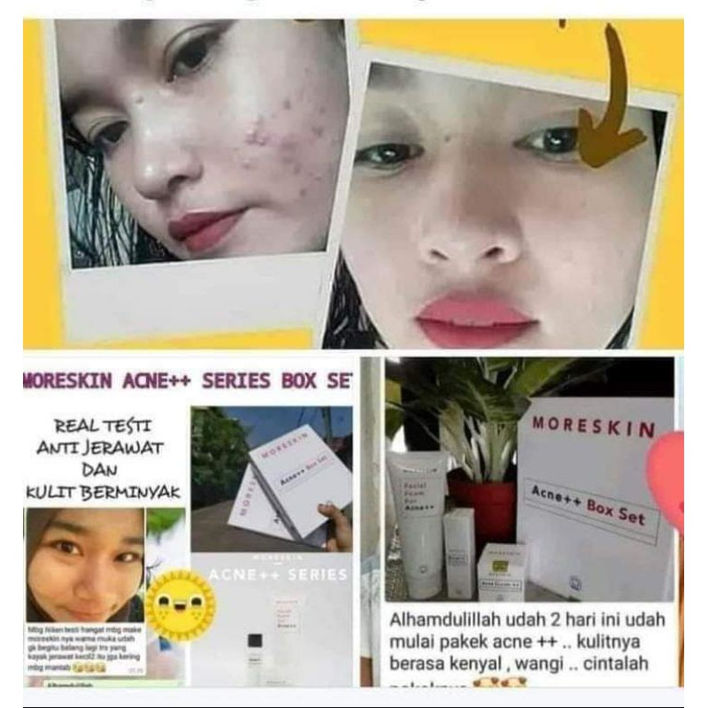 Moreskin Acne Series