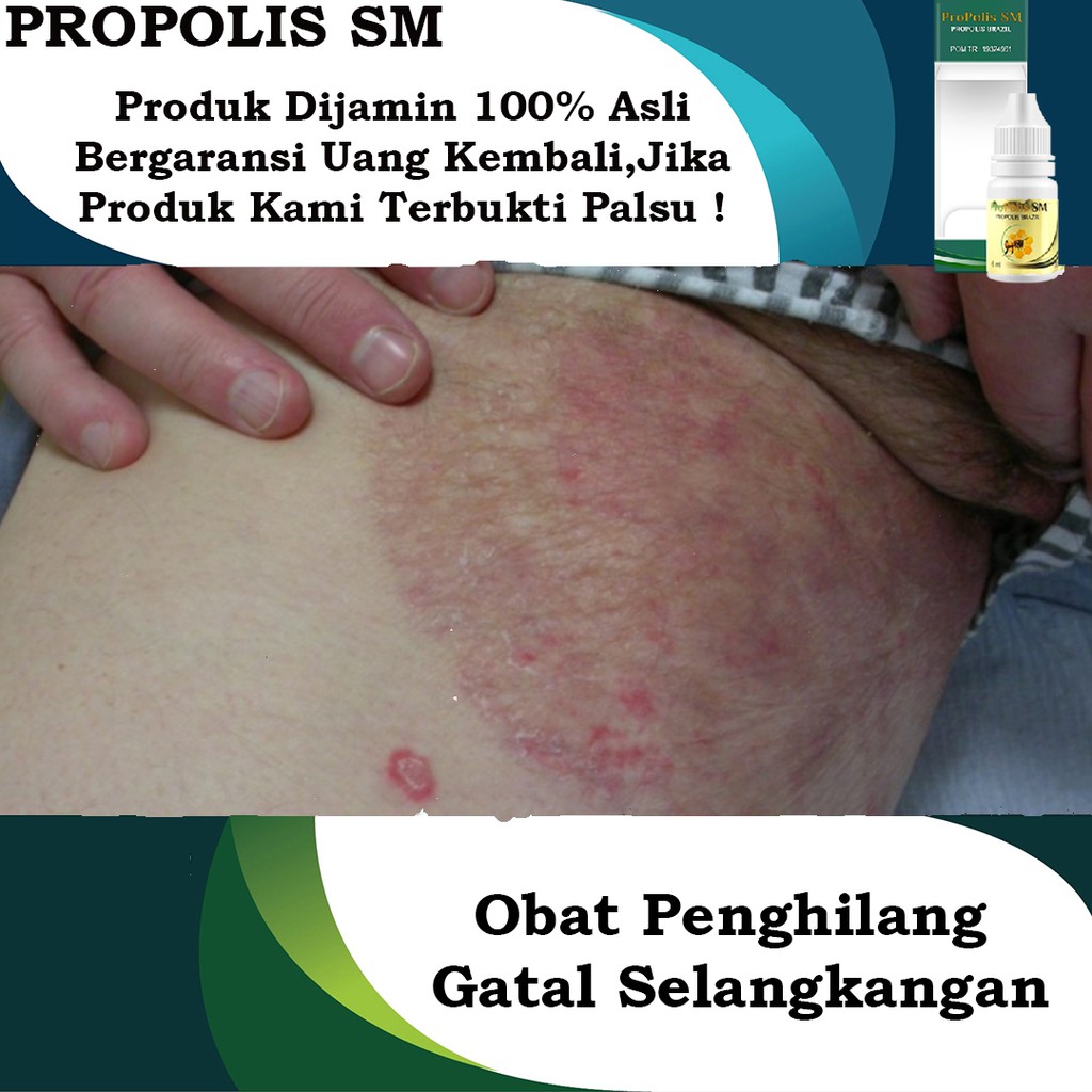 Obat Penghilang Jampes - Gatal Di Selangkangan - Gatal Di Pantat / Bokong Dengan Propolis SM Minum