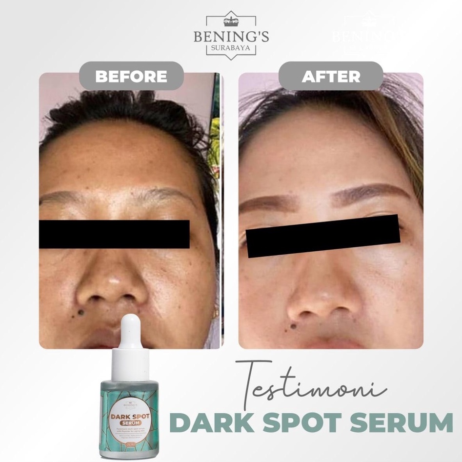 SERUM DARK SPOT BENING SKINCARE DR OKY PRATAMA  MENGATASI FLEK MELASMA MENCERAHKAN