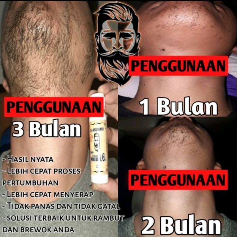 Minoxidil 6% PENUMBUH RAMBUT, BREWOK TANPA GEN! ORIGINAL 100%