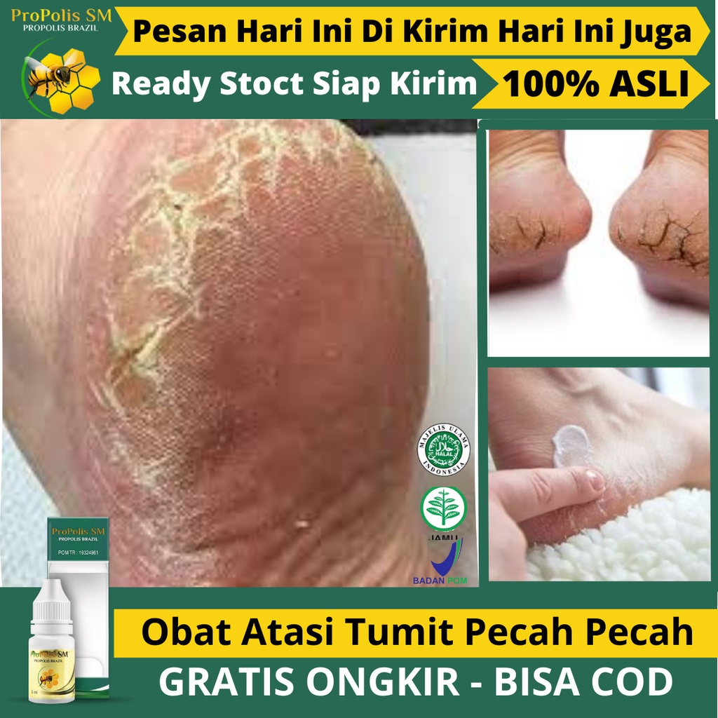 Jual Obat Oles Kaki Pecah Pecah Telapak Kaki Pecah Pecah Telapak Kaki