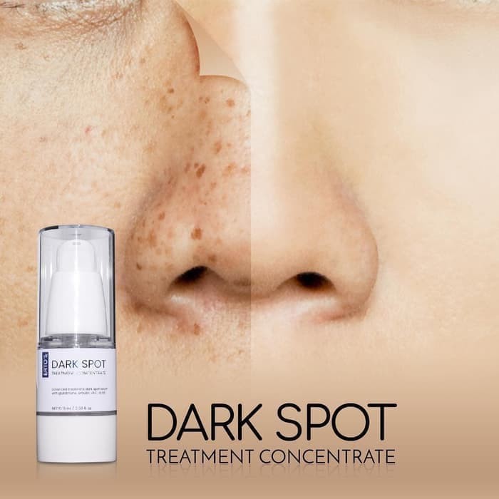 [ ERTOS ] Dark spot ~ Menghilangkan Flek Hitam Pada Wajah Kusam