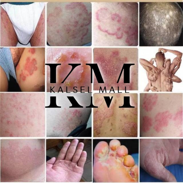 Salep Cream Krim Krem Obat Salap Gatal Yiganerjing ORIGINAL 100% Alergi Jamur Panu Kadas Ruam Eksim Selangkangan Jamuran Jerawat Kudis Korengan Kurap Kutu Air Psoriasis Skabies Panuan Keputihan Cina Herbal Tradisional OC13