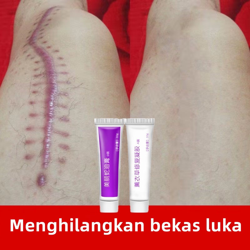 Gel Bekas Luka Krim Bekas Luka 30gr Penghapusan Bekas Luka Jerawat Membakar Stretch Mark Scab Krim Penghilang Bekas Luka Minyak Ular