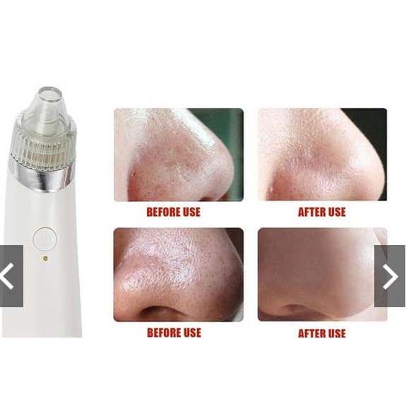 PROMO MURAH ALAT PENYEDOT KOMEDO LISTRIK/ Mengangkat komedo wajah