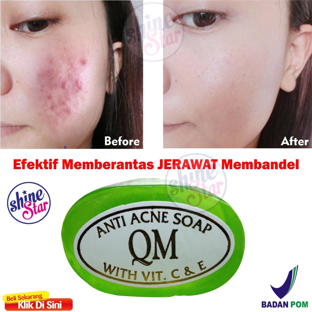 SHINE STAR - ORIGINAL 100% BPOM Sabun QM Anti Acne -Sabun Ampuh Menghilangkan Jerawat dan Bekas Jerawat /Flek