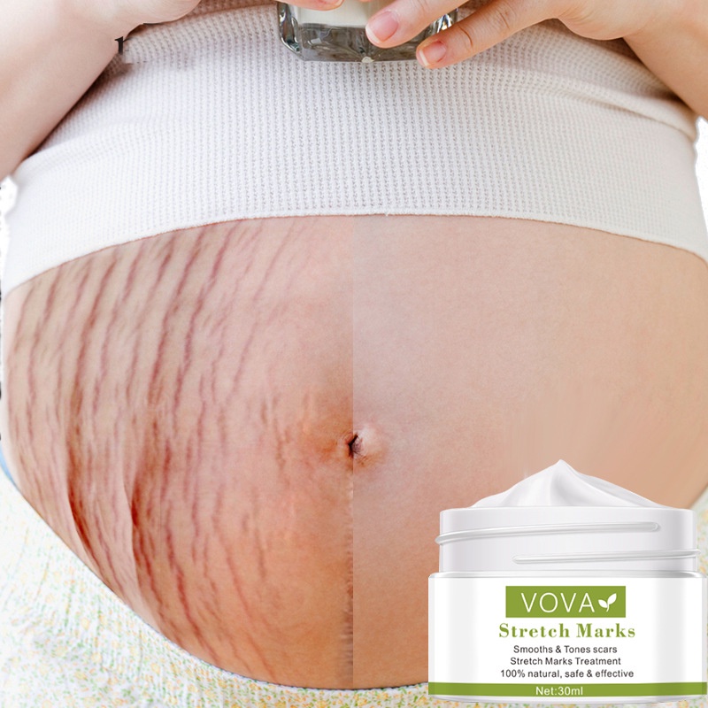 Krim Kehamilan StretchMark 30ml Cream krim bekas luka Pengencang Kulit Solusi Perut Gatal dan Anti Stretchmark Ibu Hamil StretchMark Krim Penghilang Stretch Mark mama choice stretch mark