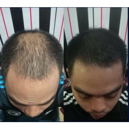 Produk Kebotakan Minoxidil dan Peomix Hair Oil