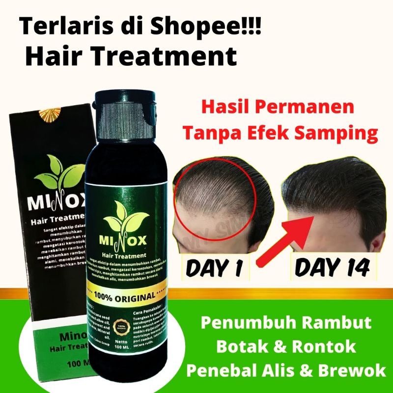 Paket 5 Pcs Minox Hair Treatments Penumbuh Rambut Botak dan Rontok untuk Pria dan Wanita isi 100 ML/btl