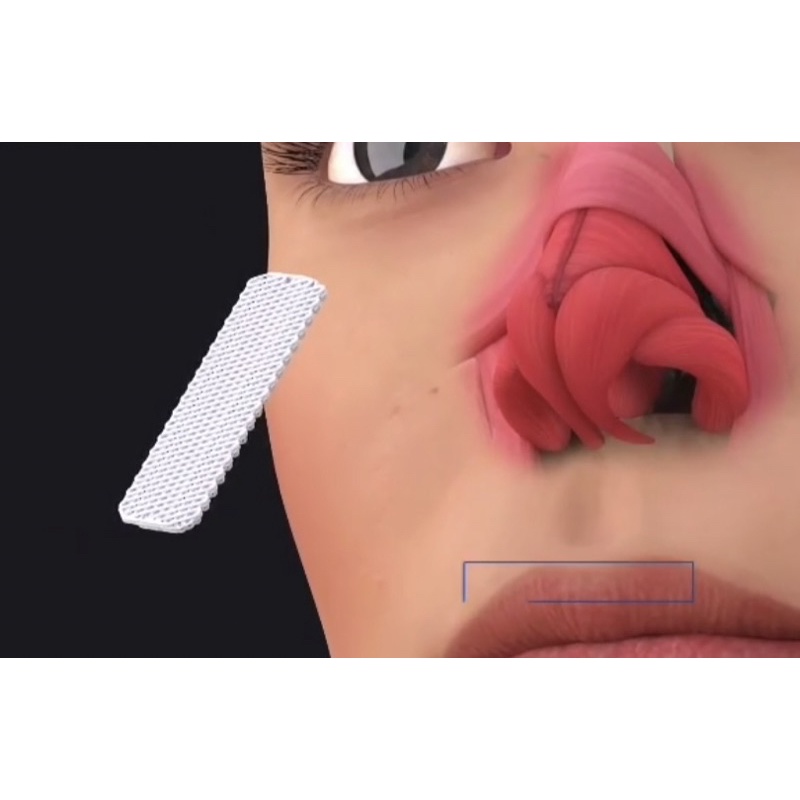 implant ujung hidung mancung