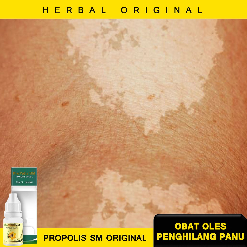 Obat Oles Panu Hapur Herbal Alami, Penghilang Panu Membandel Wajah maupun Badan Karena Herbal