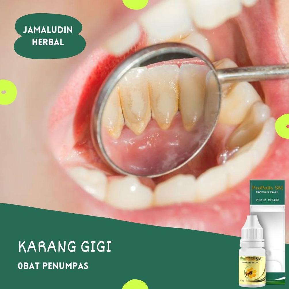 Obat Sakit Gigi - Sakit Gigi - Abses Gusi - Propolis Sm Asli